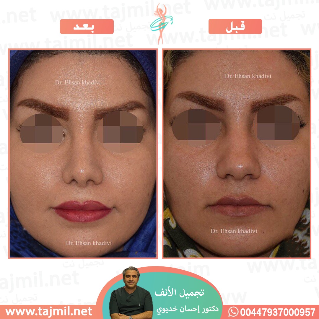  - دکتور إحسان خدیوي عملية تجميل الانف في ايران مع تجميل نت