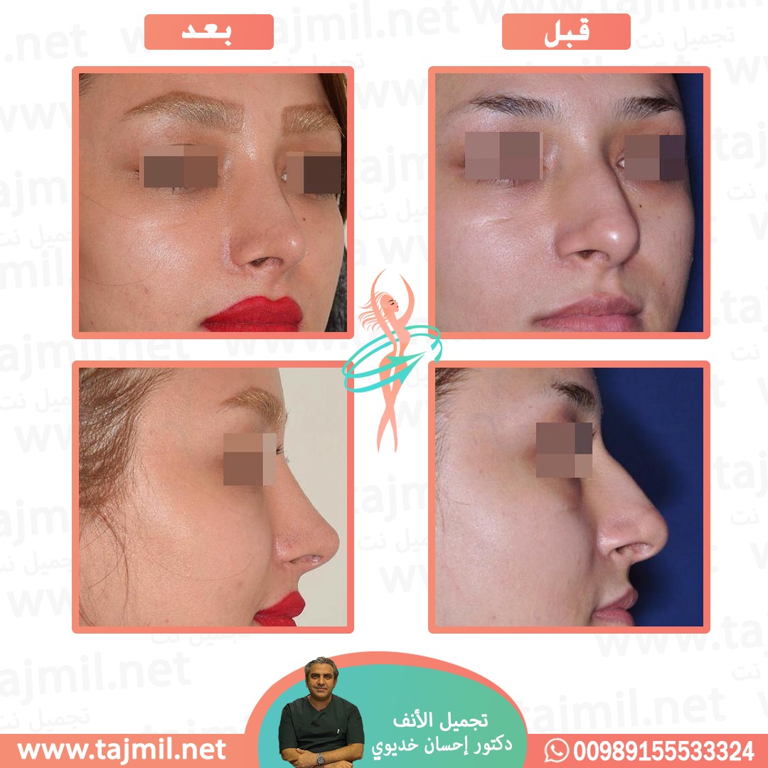  - دکتور إحسان خدیوي عملية تجميل الانف في ايران مع تجميل نت