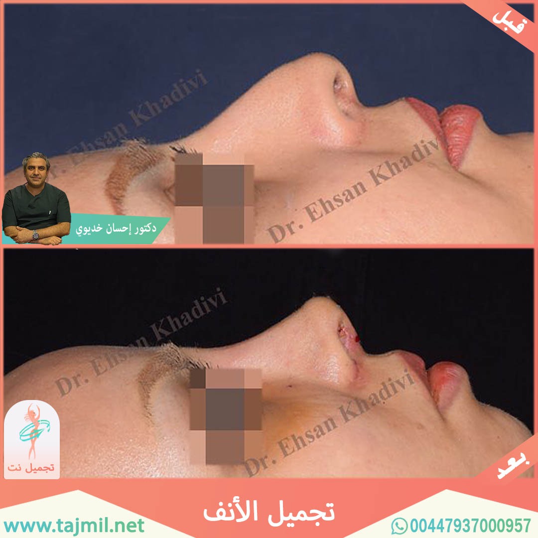  - دکتور إحسان خدیوي عملية تجميل الانف في ايران مع تجميل نت