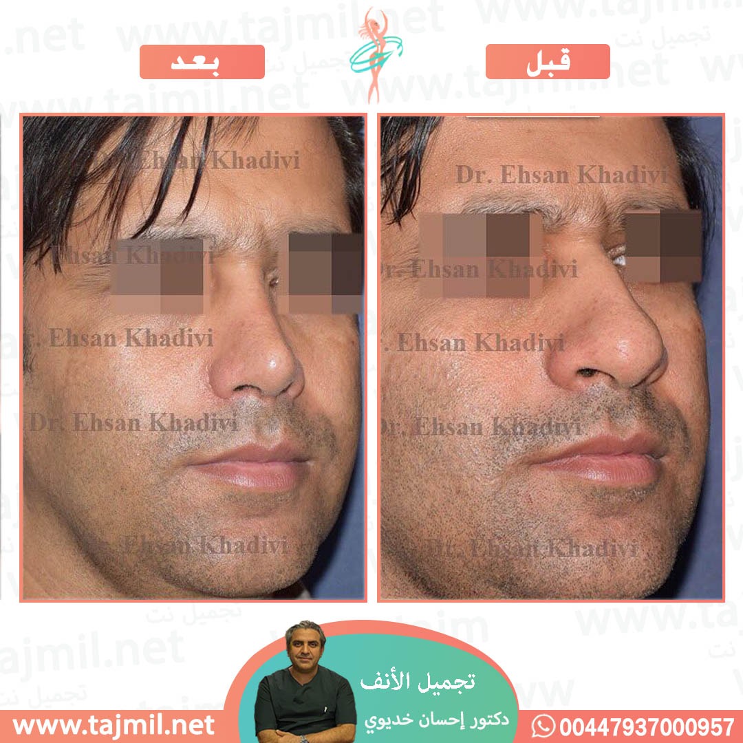  - دکتور إحسان خدیوي عملية تجميل الانف في ايران مع تجميل نت