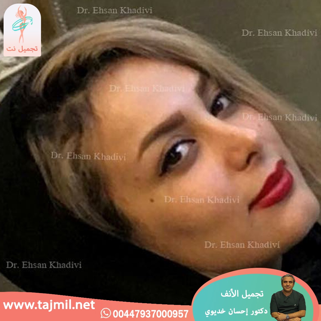  - دکتور إحسان خدیوي عملية تجميل الانف في ايران مع تجميل نت