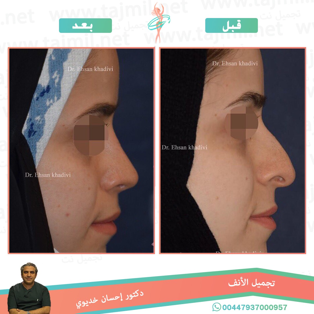  - دکتور إحسان خدیوي عملية تجميل الانف في ايران مع تجميل نت