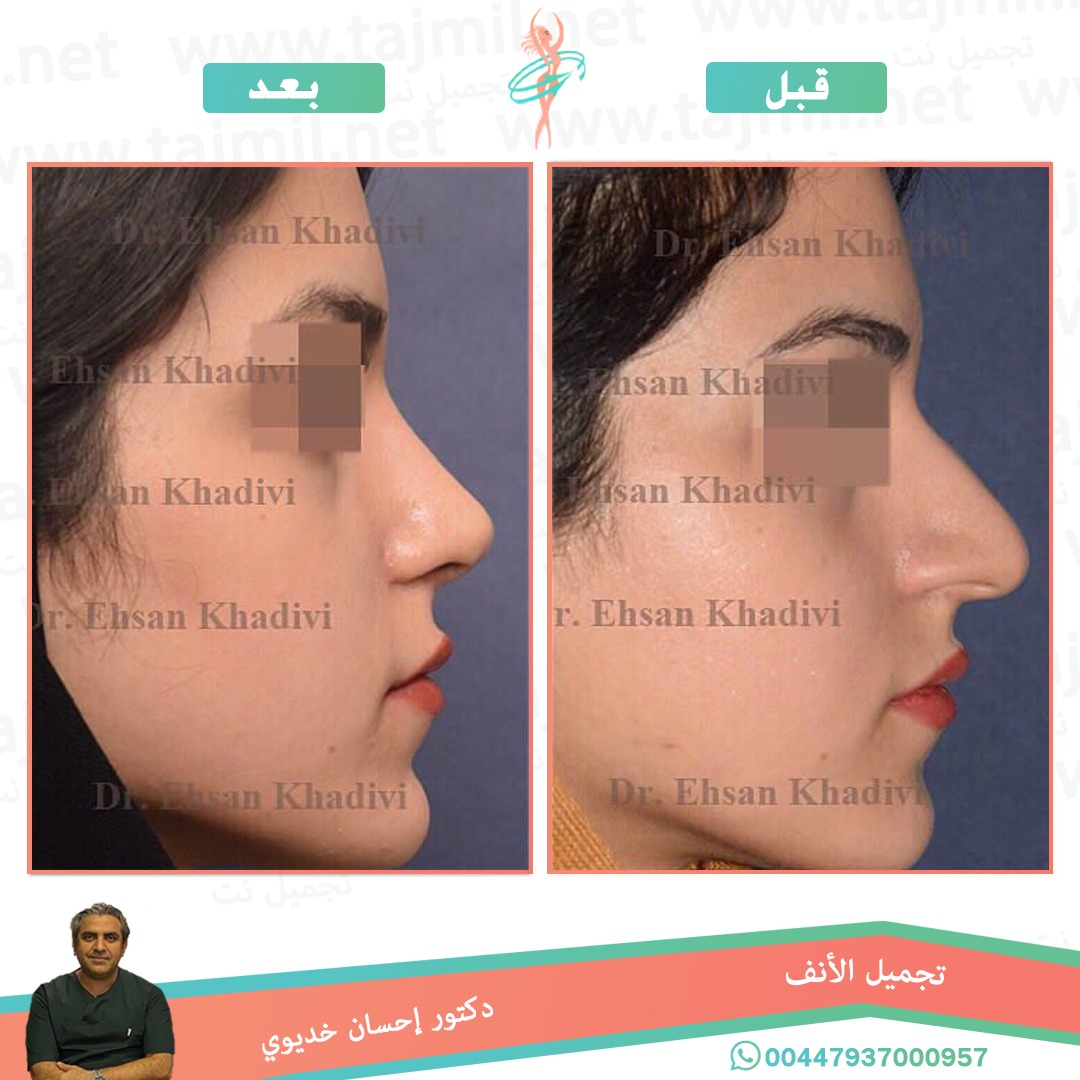  - دکتور إحسان خدیوي عملية تجميل الانف في ايران مع تجميل نت