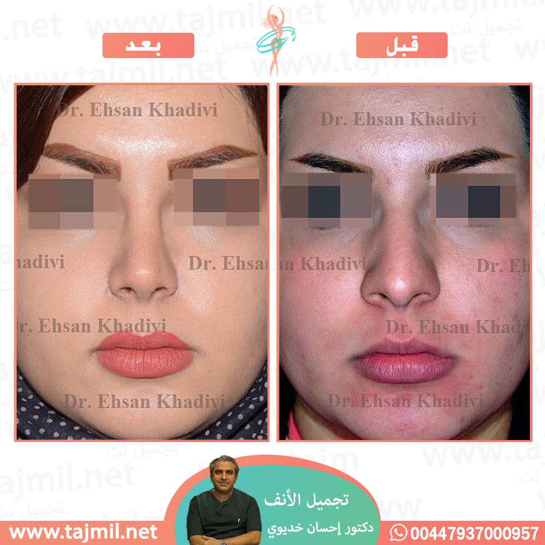  - دکتور إحسان خدیوي عملية تجميل الانف في ايران مع تجميل نت