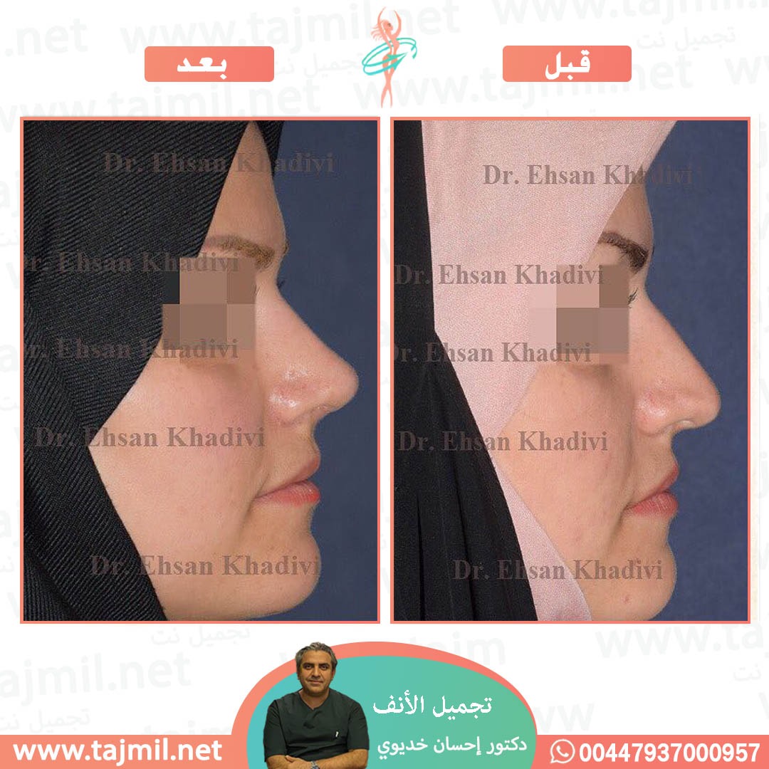  - دکتور إحسان خدیوي عملية تجميل الانف في ايران مع تجميل نت