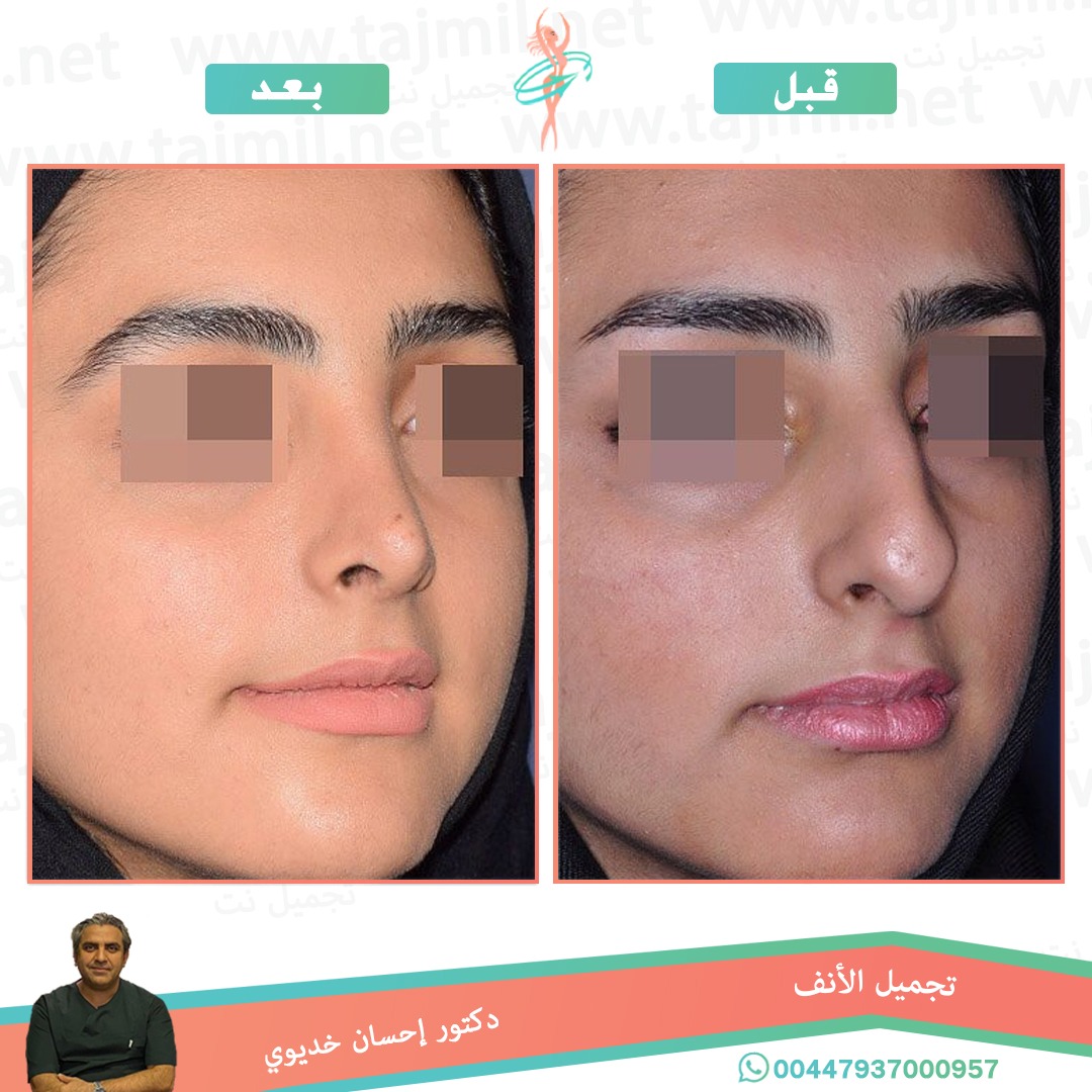  - دکتور إحسان خدیوي عملية تجميل الانف في ايران مع تجميل نت