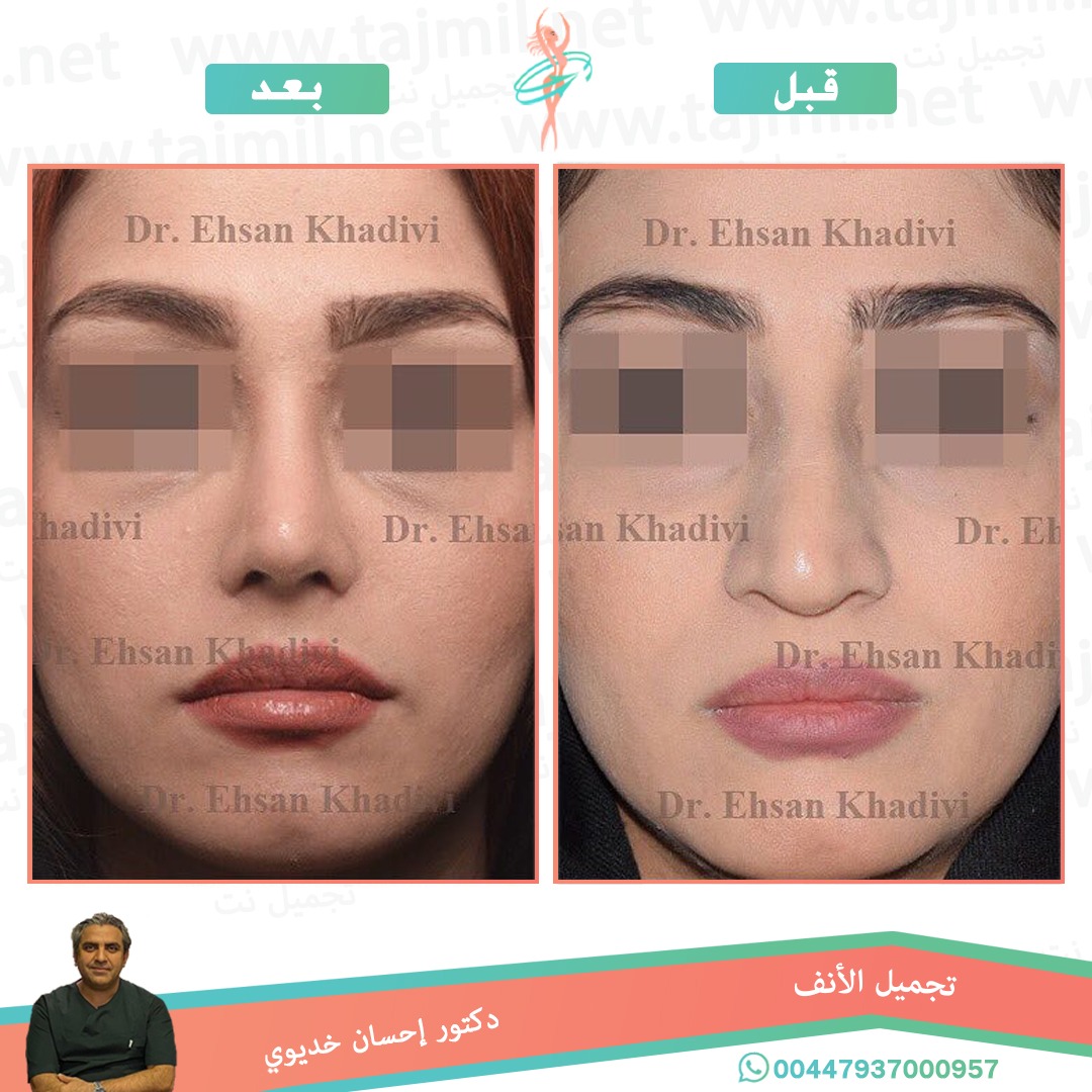  - دکتور إحسان خدیوي عملية تجميل الانف في ايران مع تجميل نت