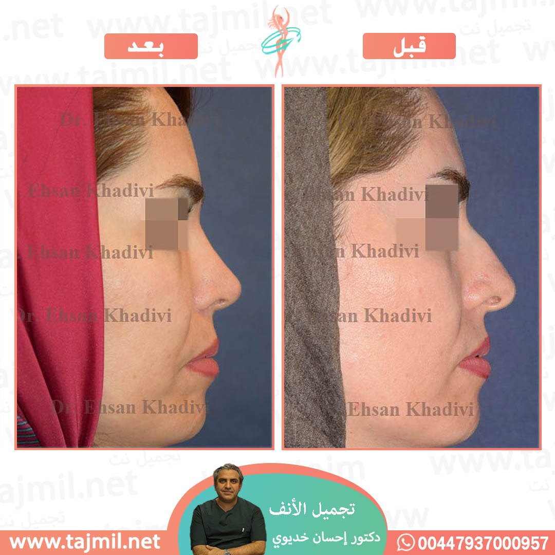  - دکتور إحسان خدیوي عملية تجميل الانف في ايران مع تجميل نت