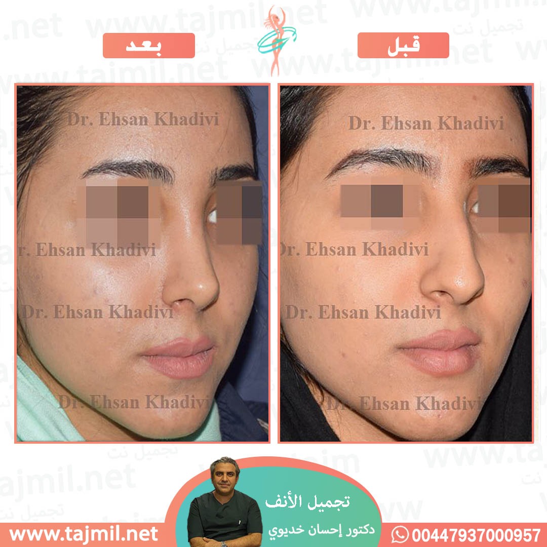  - دکتور إحسان خدیوي عملية تجميل الانف في ايران مع تجميل نت