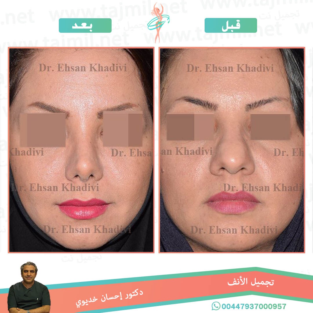  - دکتور إحسان خدیوي عملية تجميل الانف في ايران مع تجميل نت