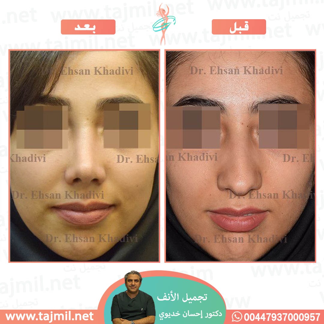  - دکتور إحسان خدیوي عملية تجميل الانف في ايران مع تجميل نت