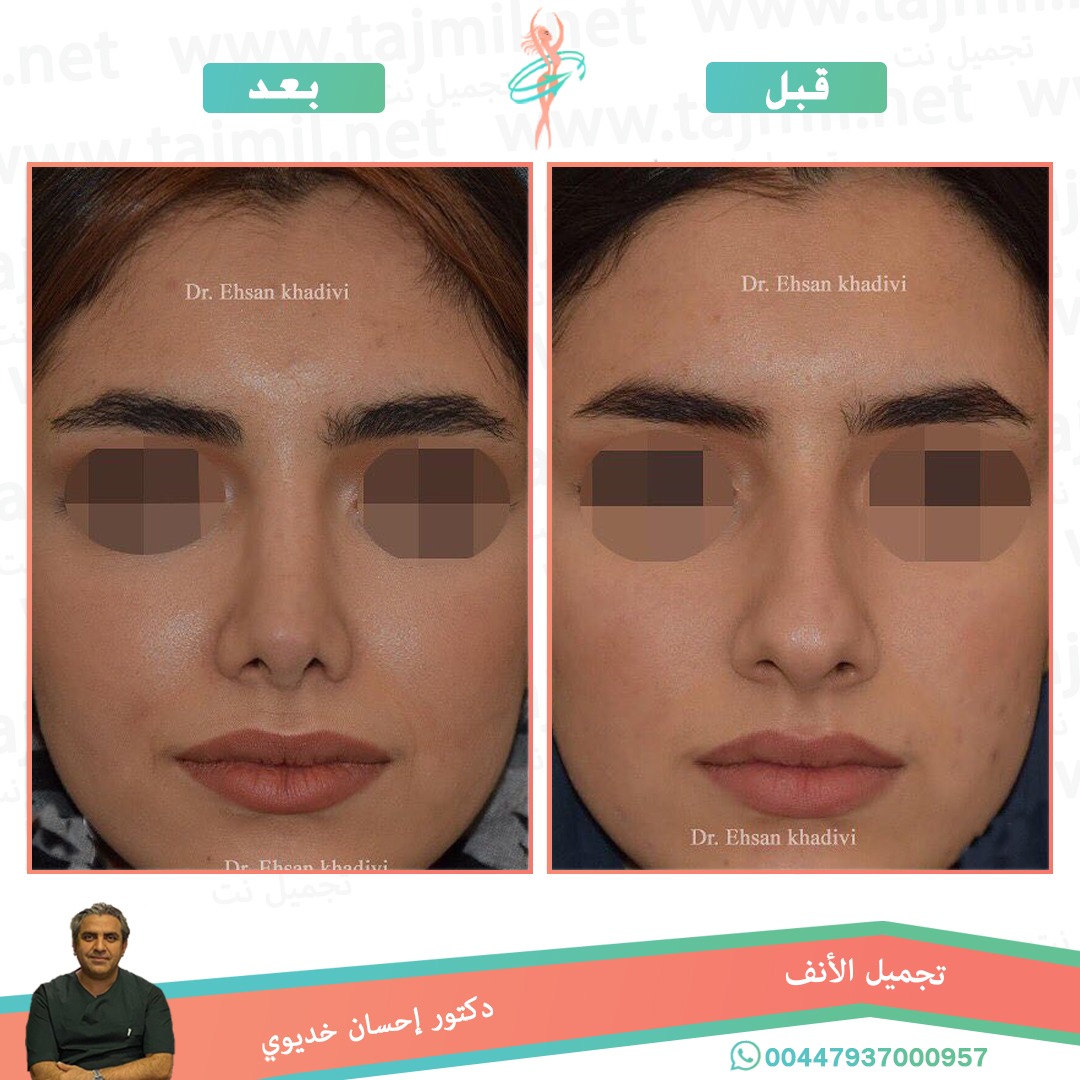  - دکتور إحسان خدیوي عملية تجميل الانف في ايران مع تجميل نت