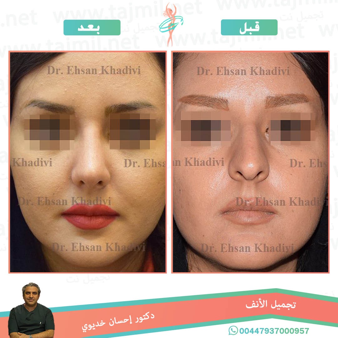  - دکتور إحسان خدیوي عملية تجميل الانف في ايران مع تجميل نت