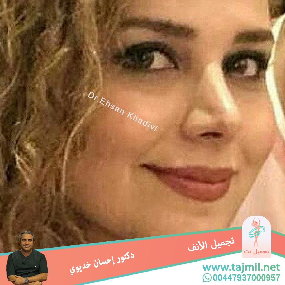  - دکتور إحسان خدیوي عملية تجميل الانف في ايران مع تجميل نت