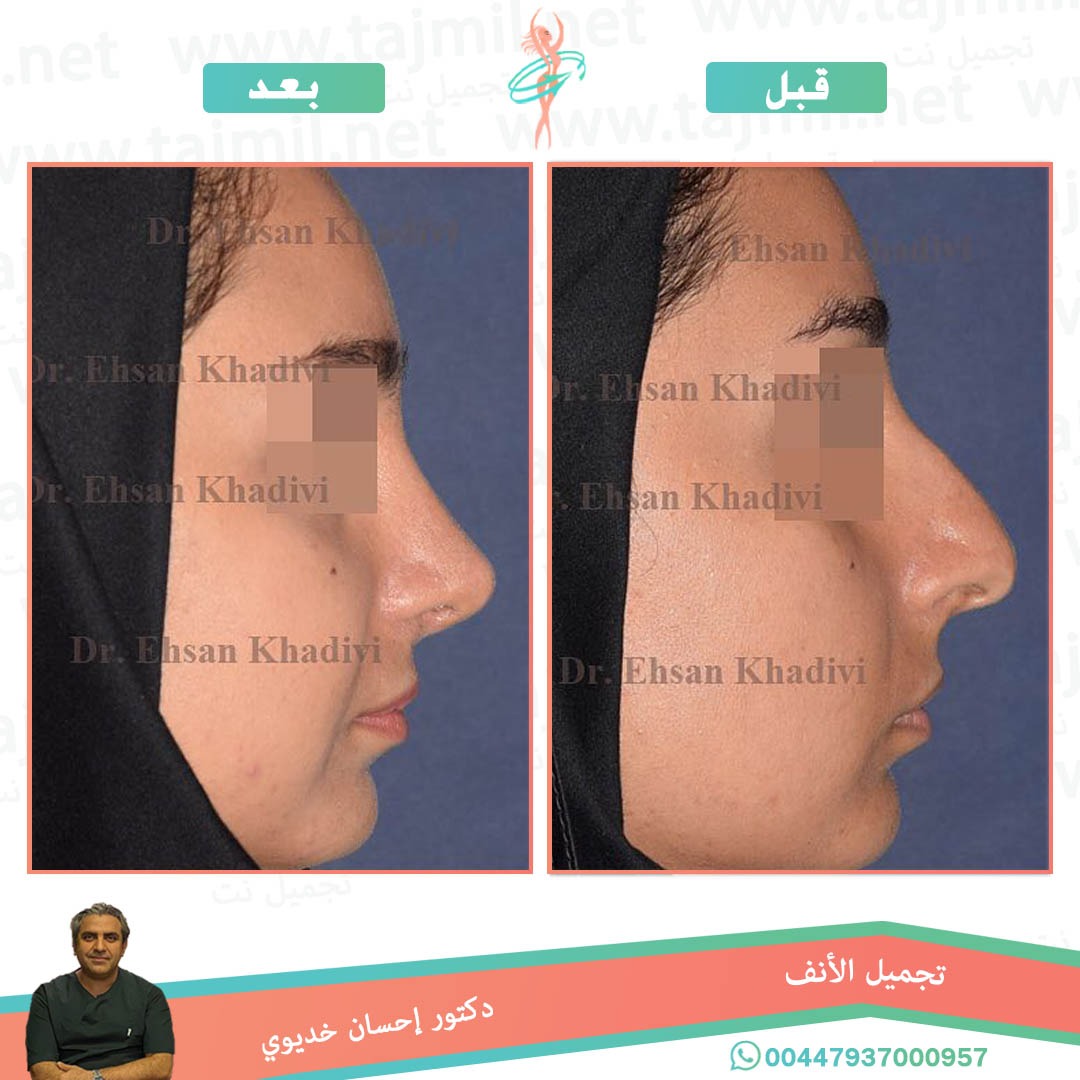  - دکتور إحسان خدیوي عملية تجميل الانف في ايران مع تجميل نت