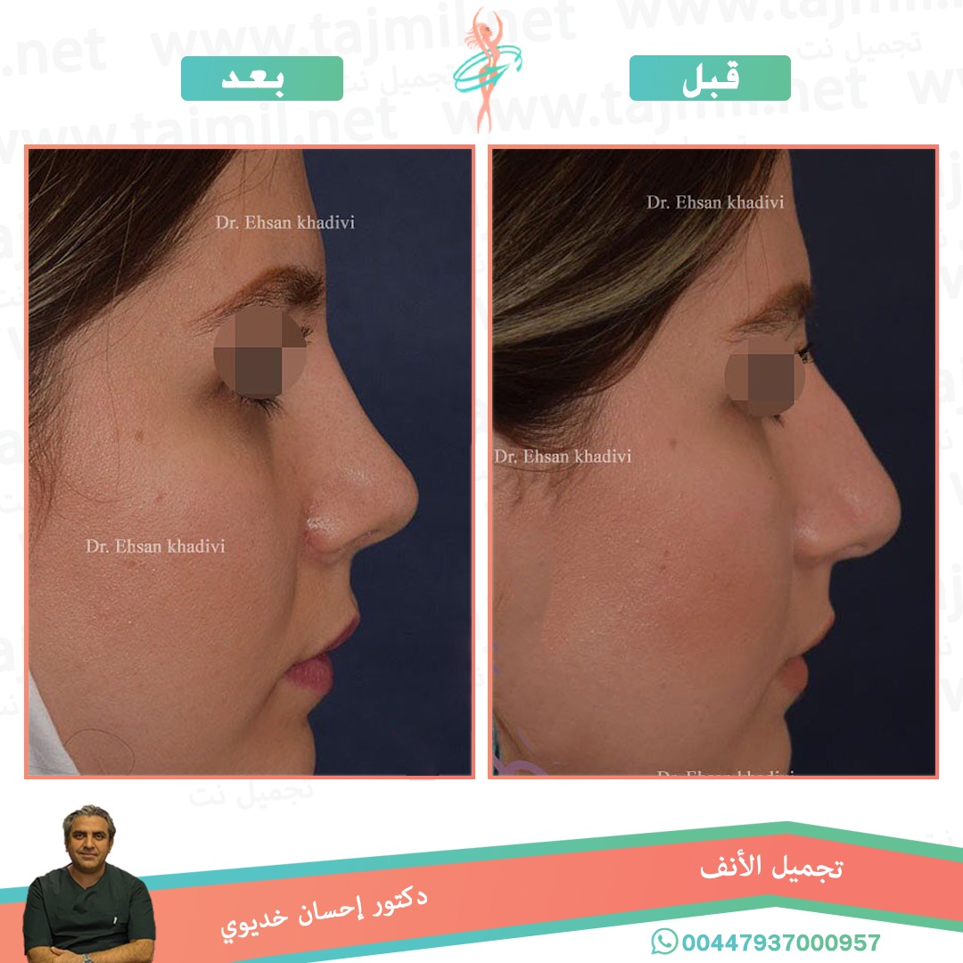  - دکتور إحسان خدیوي عملية تجميل الانف في ايران مع تجميل نت