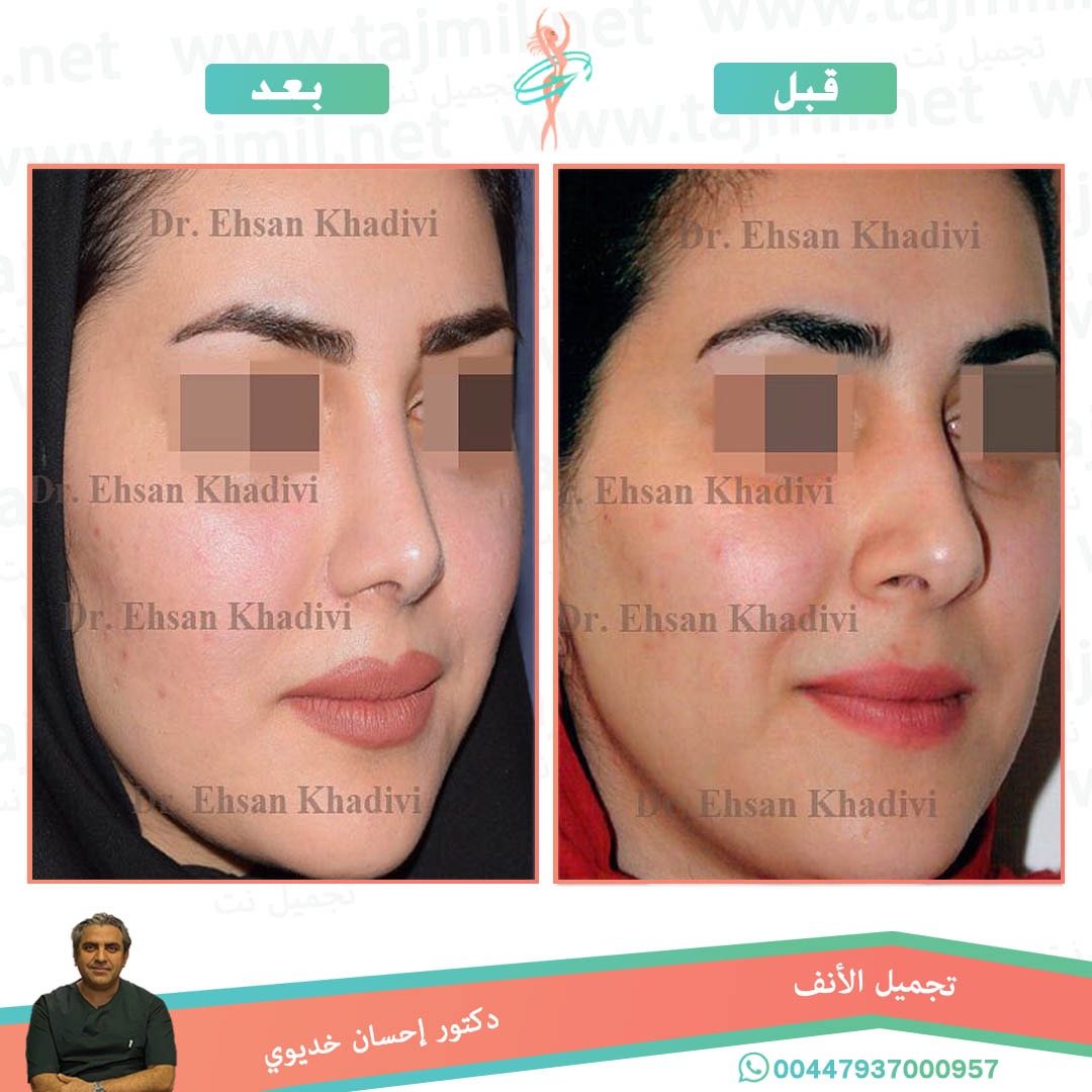  - دکتور إحسان خدیوي عملية تجميل الانف في ايران مع تجميل نت