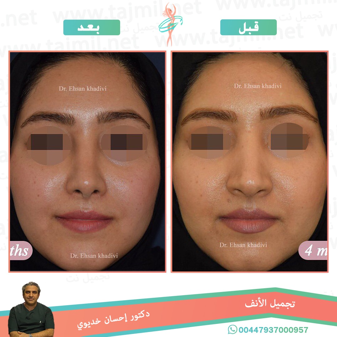  - دکتور إحسان خدیوي عملية تجميل الانف في ايران مع تجميل نت