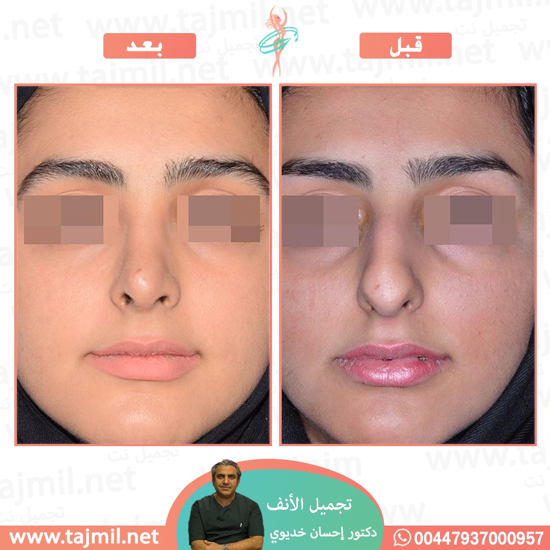  - دکتور إحسان خدیوي عملية تجميل الانف في ايران مع تجميل نت