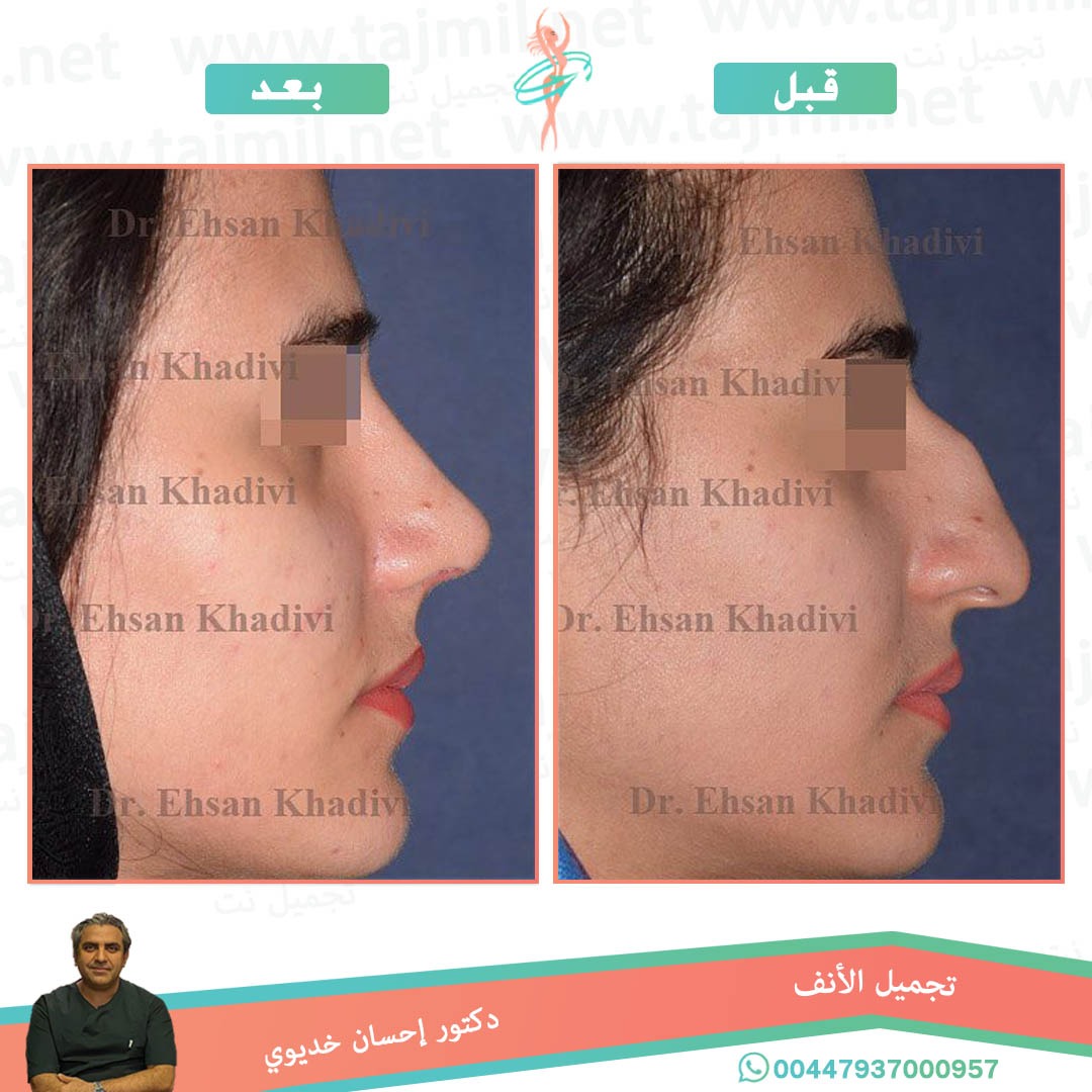  - دکتور إحسان خدیوي عملية تجميل الانف في ايران مع تجميل نت