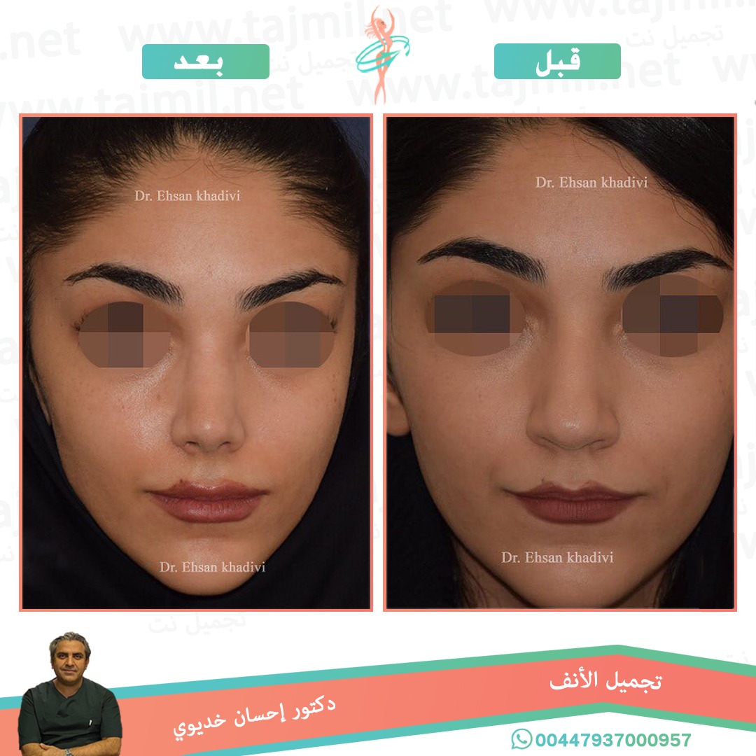  - دکتور إحسان خدیوي عملية تجميل الانف في ايران مع تجميل نت