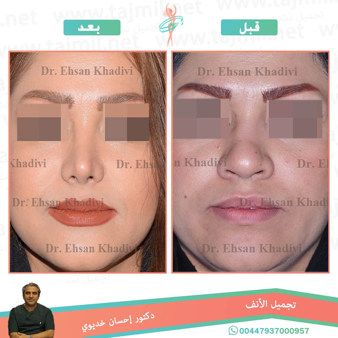  - دکتور إحسان خدیوي عملية تجميل الانف في ايران مع تجميل نت