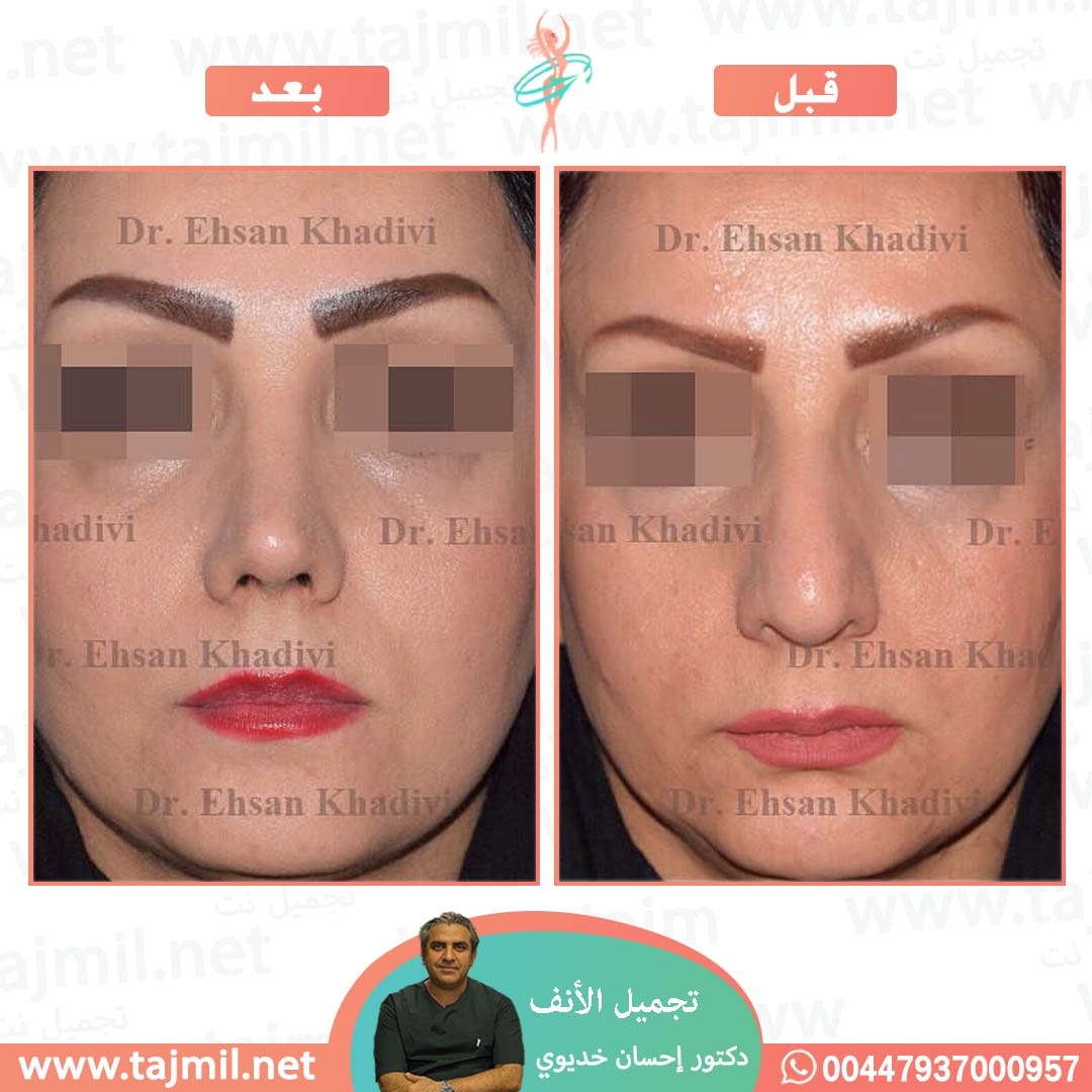  - دکتور إحسان خدیوي عملية تجميل الانف في ايران مع تجميل نت