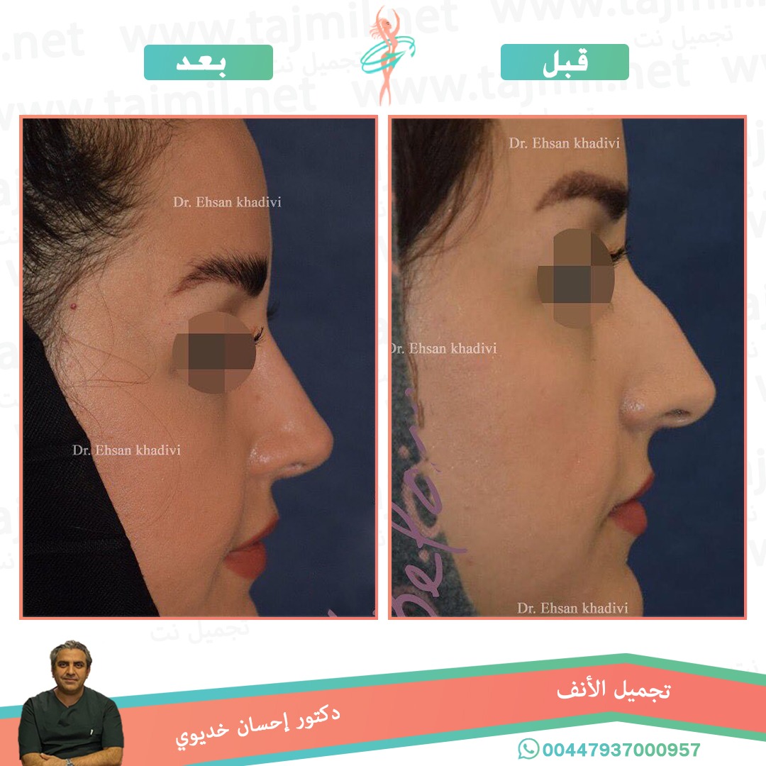  - دکتور إحسان خدیوي عملية تجميل الانف في ايران مع تجميل نت