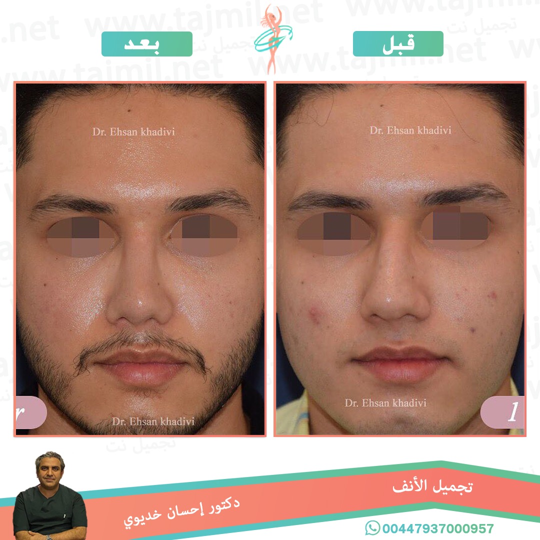  - دکتور إحسان خدیوي عملية تجميل الانف في ايران مع تجميل نت