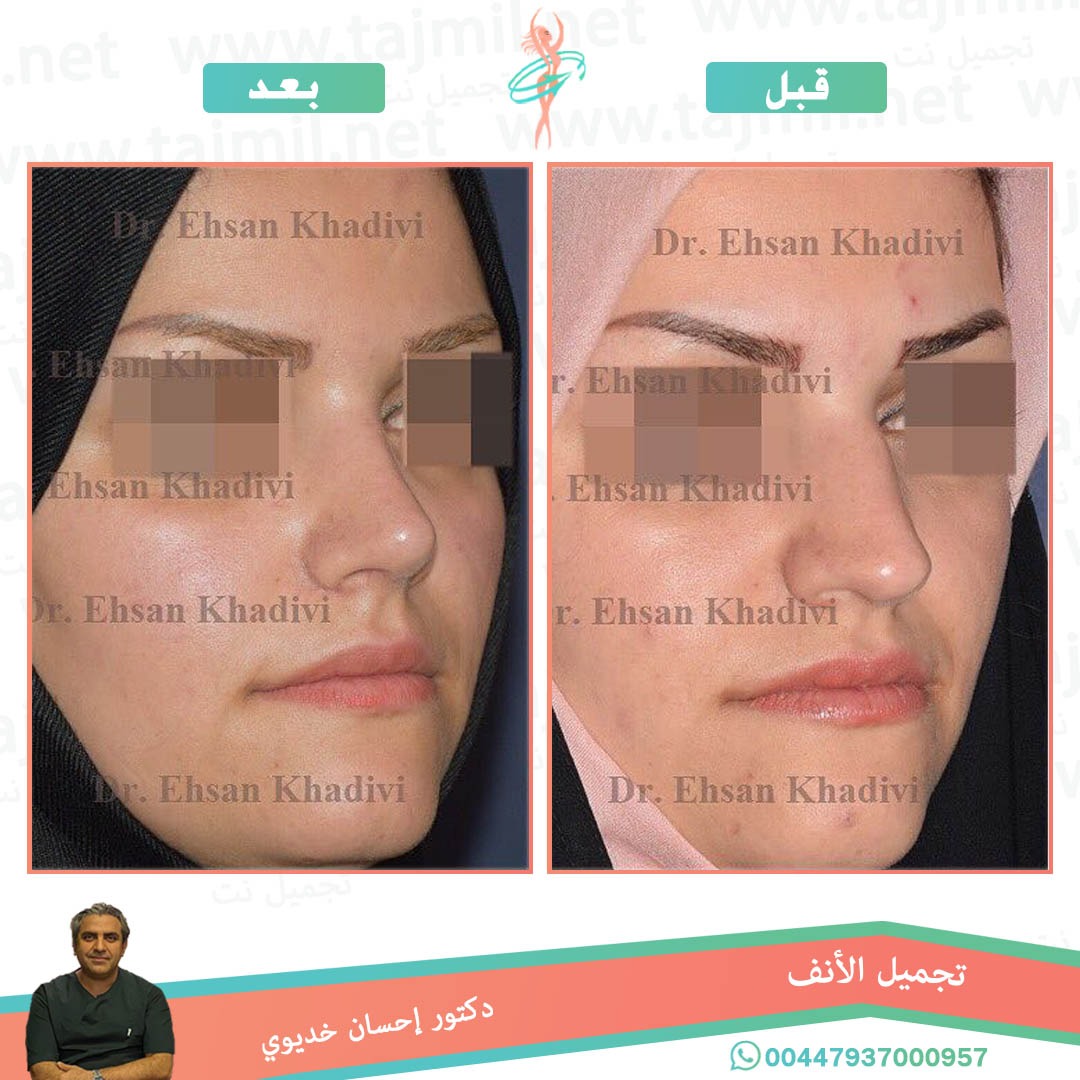  - دکتور إحسان خدیوي عملية تجميل الانف في ايران مع تجميل نت