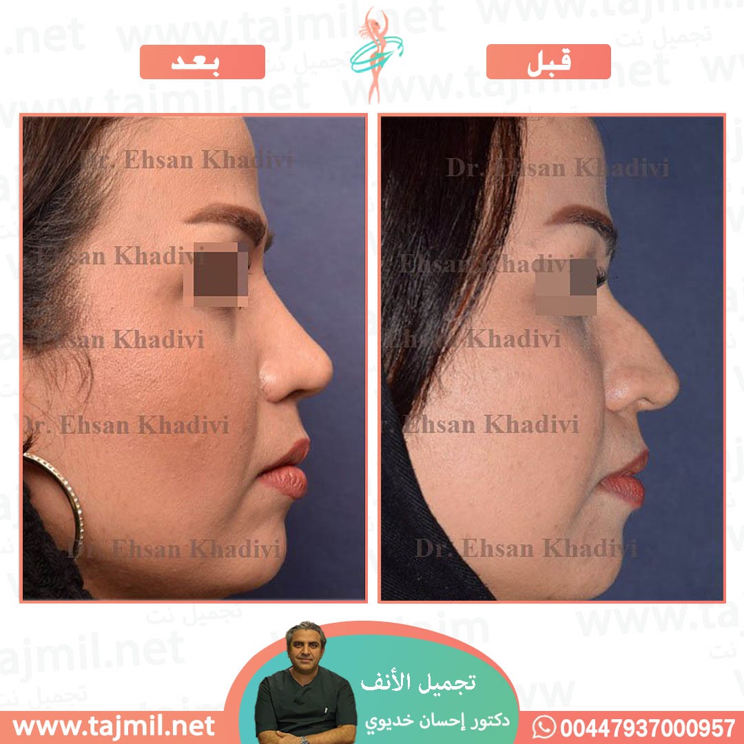  - دکتور إحسان خدیوي عملية تجميل الانف في ايران مع تجميل نت