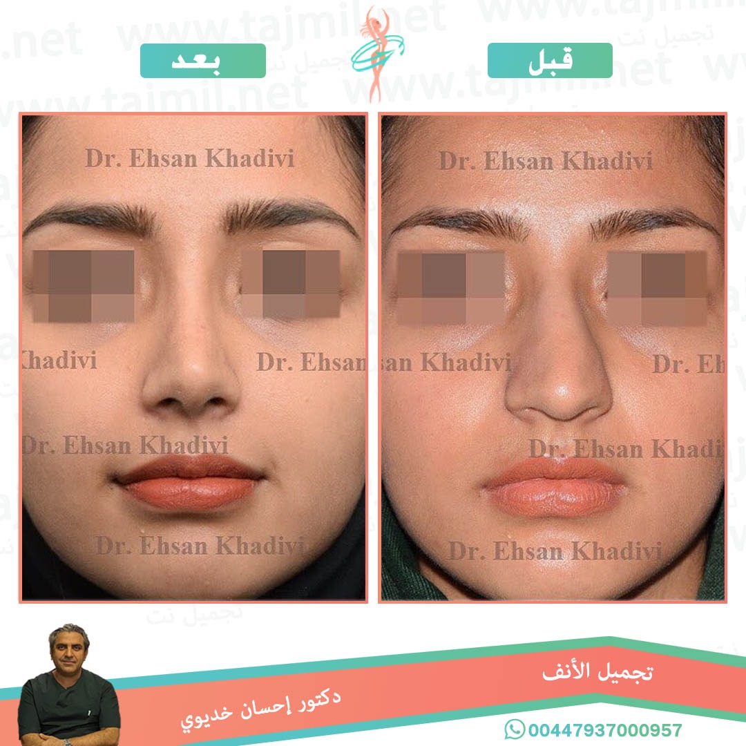  - دکتور إحسان خدیوي عملية تجميل الانف في ايران مع تجميل نت