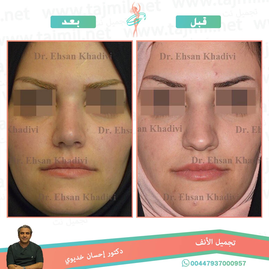  - دکتور إحسان خدیوي عملية تجميل الانف في ايران مع تجميل نت