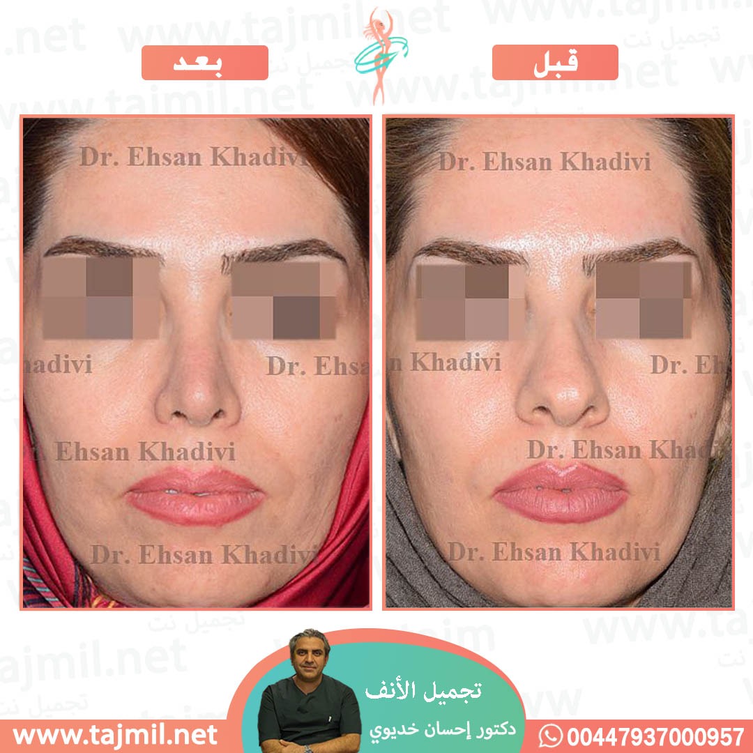  - دکتور إحسان خدیوي عملية تجميل الانف في ايران مع تجميل نت