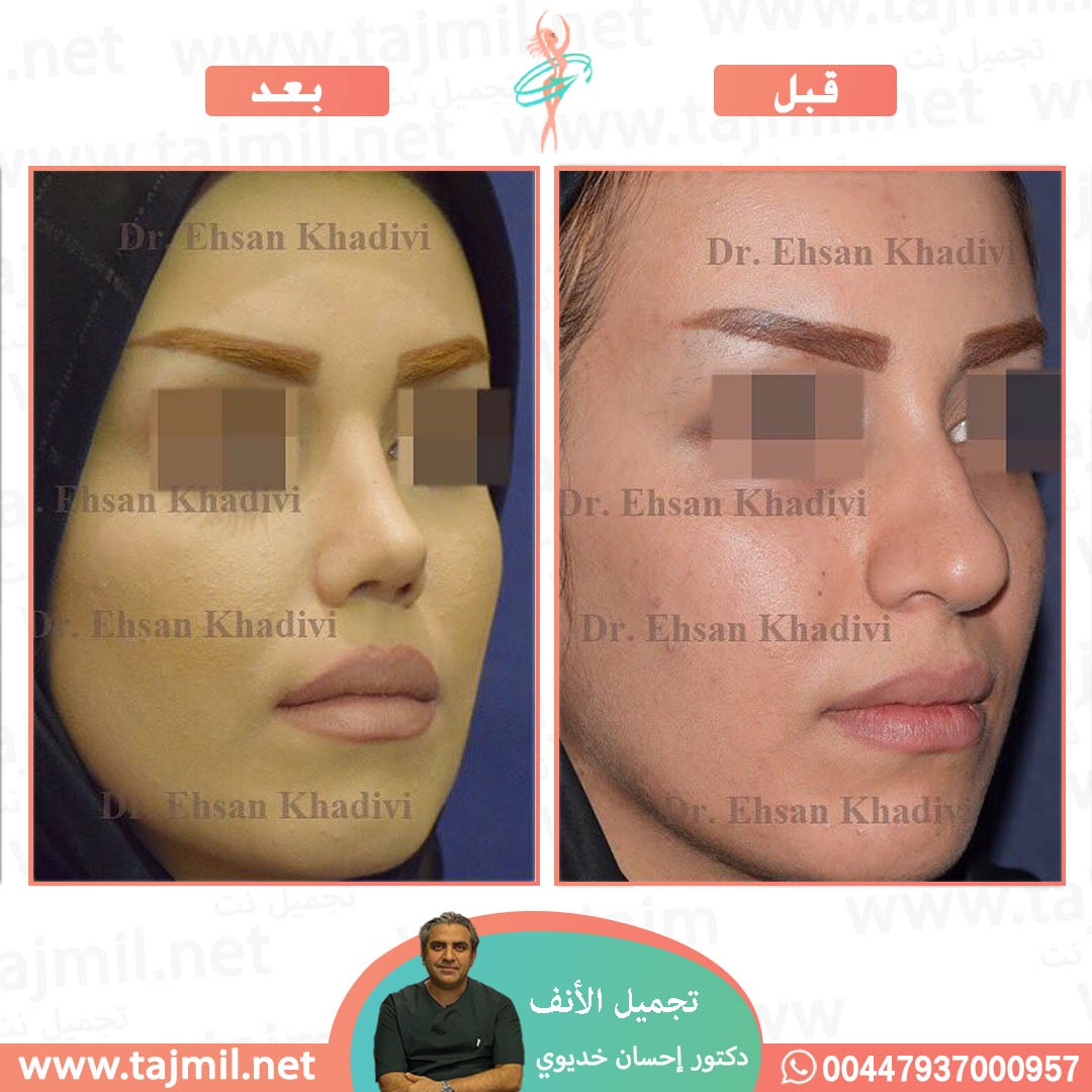  - دکتور إحسان خدیوي عملية تجميل الانف في ايران مع تجميل نت