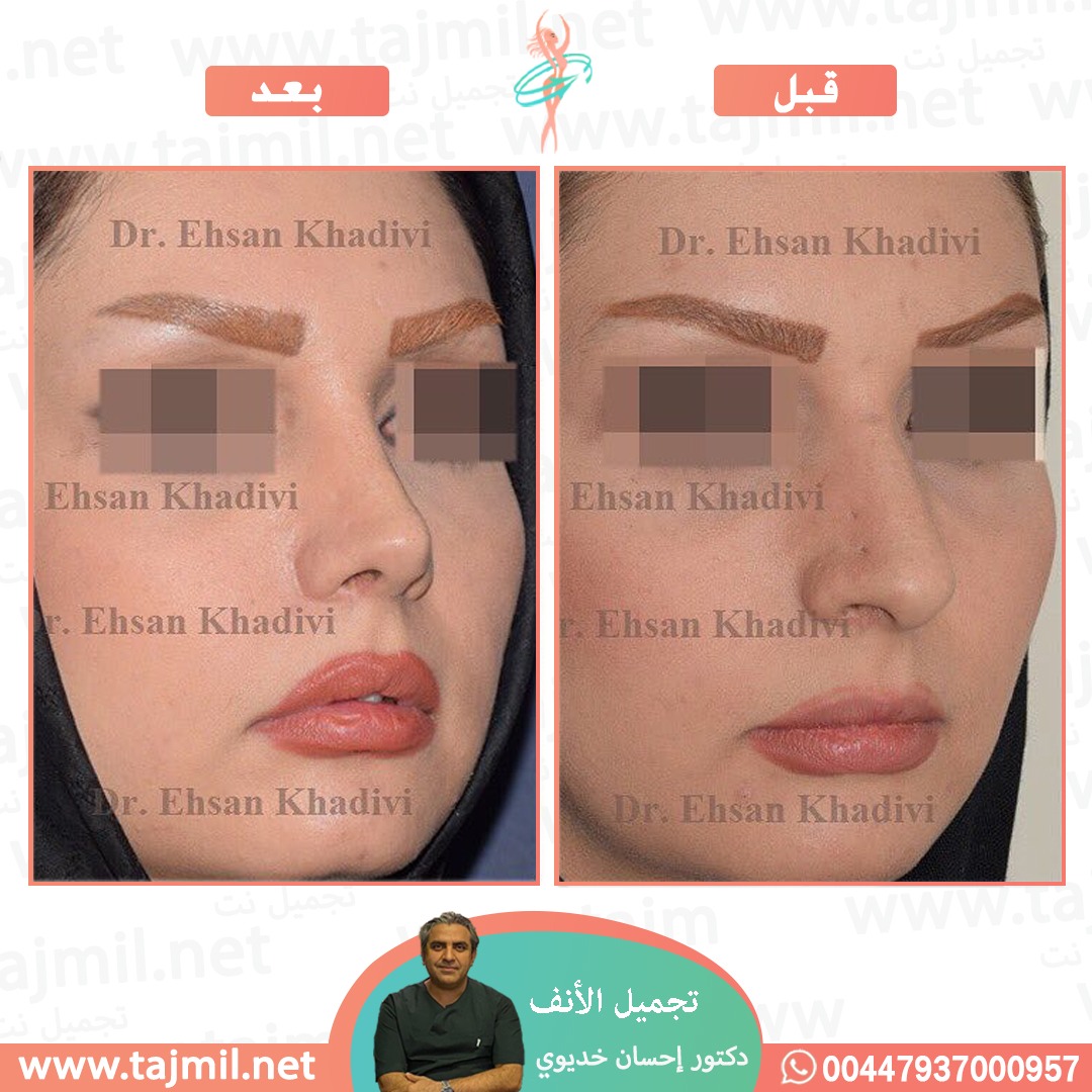  - دکتور إحسان خدیوي عملية تجميل الانف في ايران مع تجميل نت