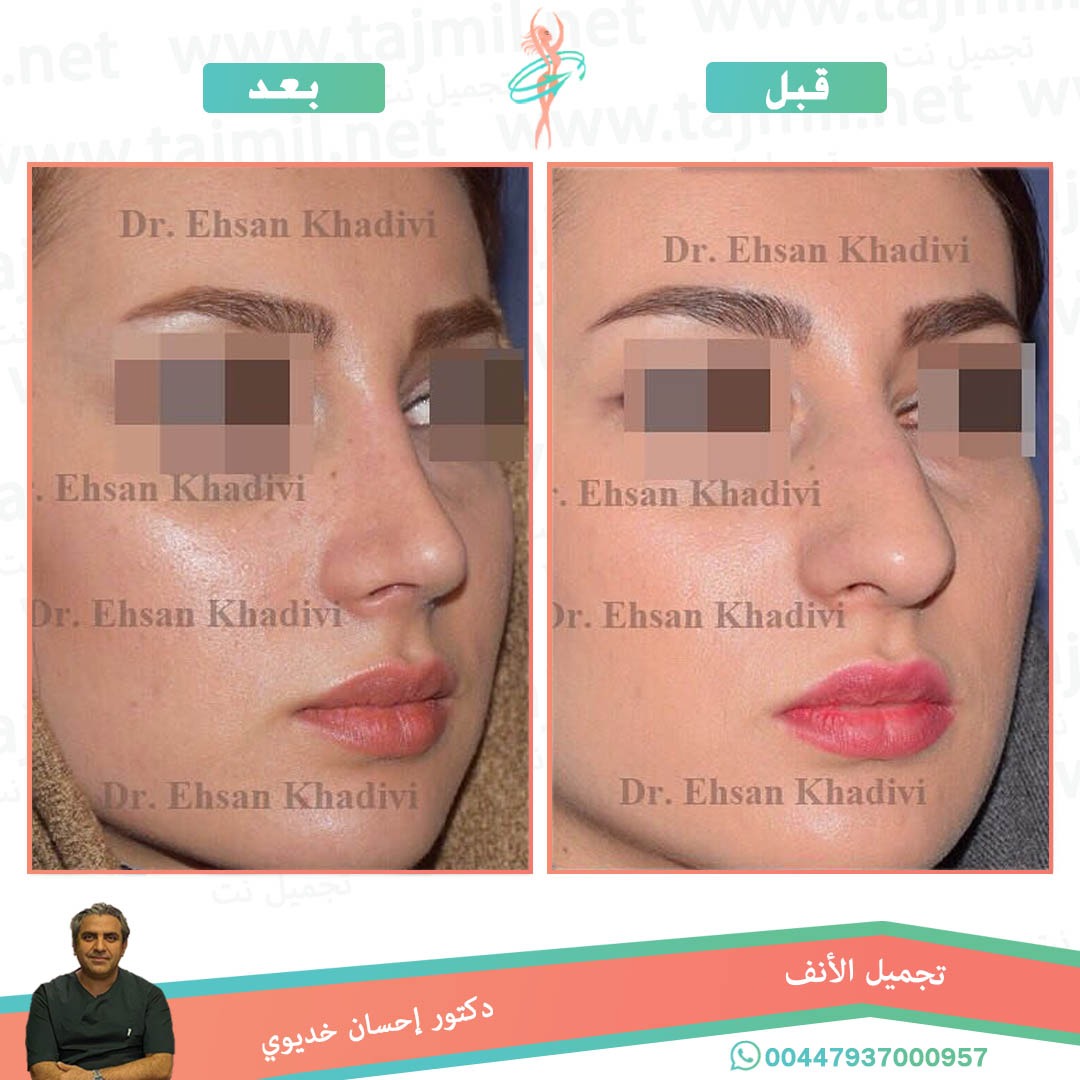  - دکتور إحسان خدیوي عملية تجميل الانف في ايران مع تجميل نت