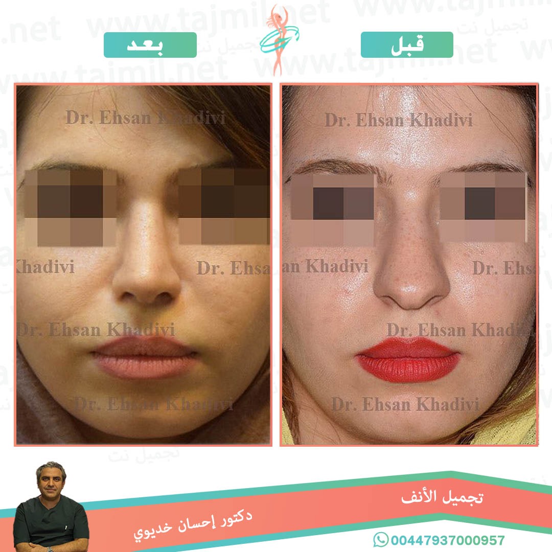  - دکتور إحسان خدیوي عملية تجميل الانف في ايران مع تجميل نت