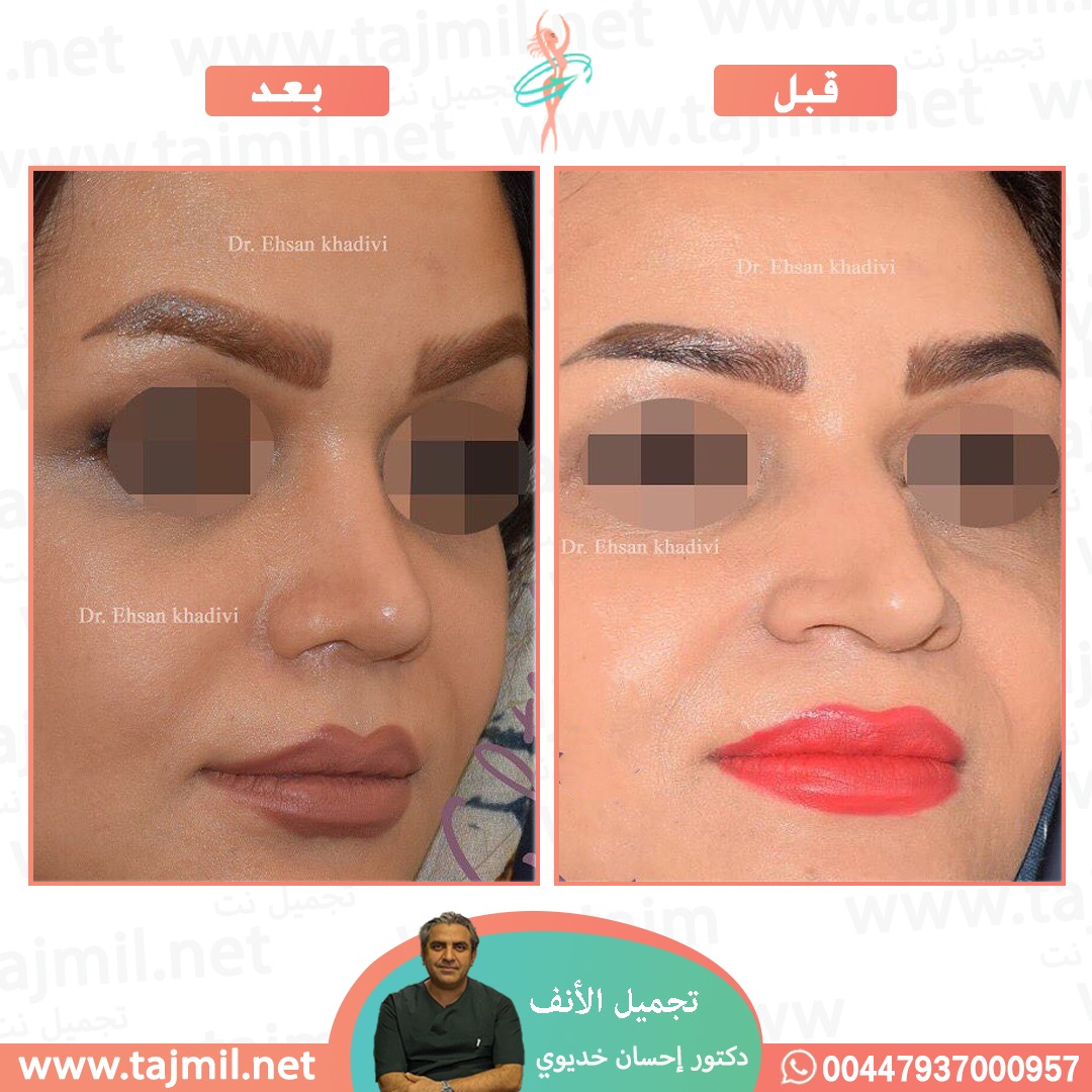  - دکتور إحسان خدیوي عملية تجميل الانف في ايران مع تجميل نت