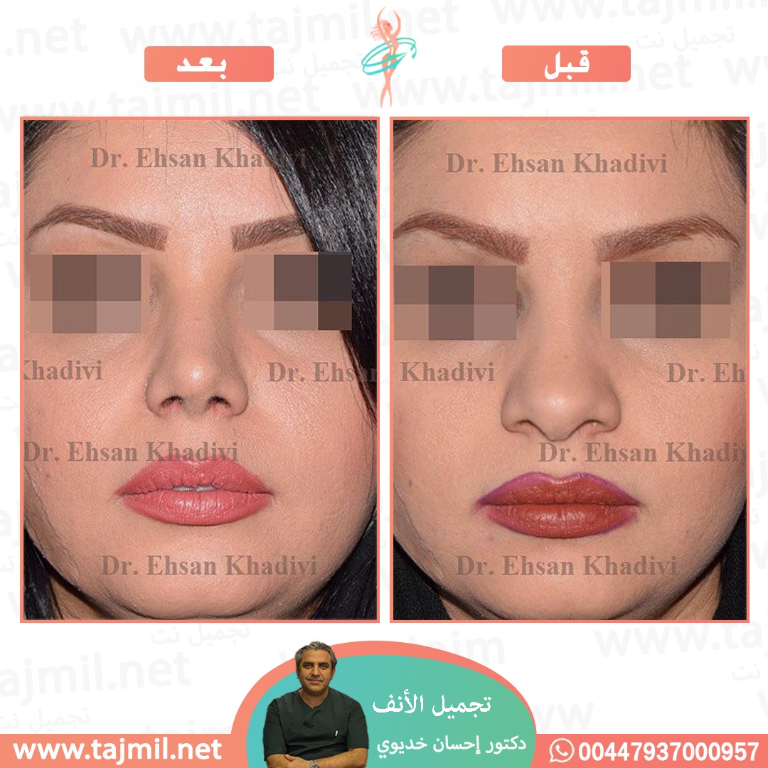  - دکتور إحسان خدیوي عملية تجميل الانف في ايران مع تجميل نت