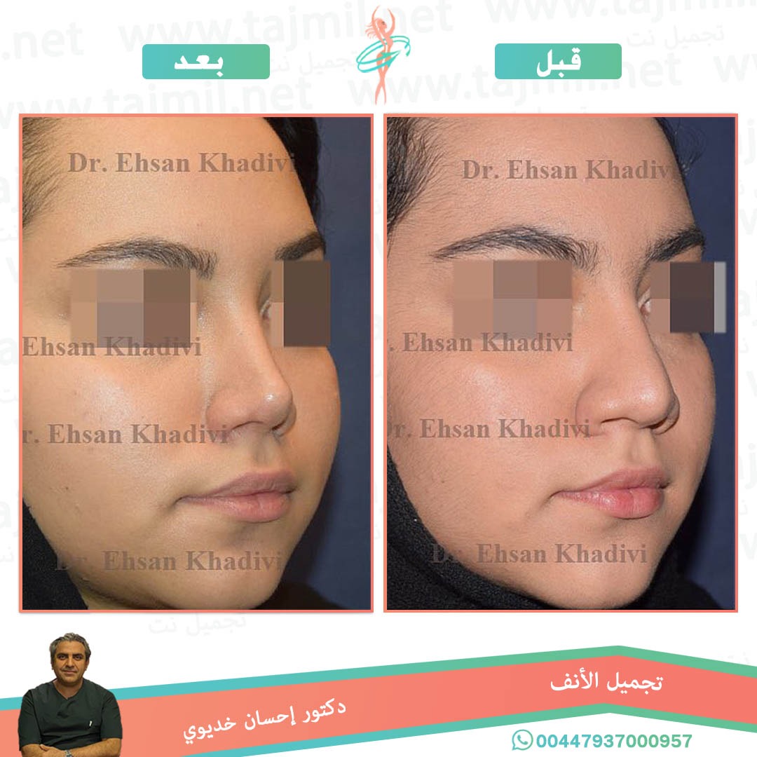  - دکتور إحسان خدیوي عملية تجميل الانف في ايران مع تجميل نت