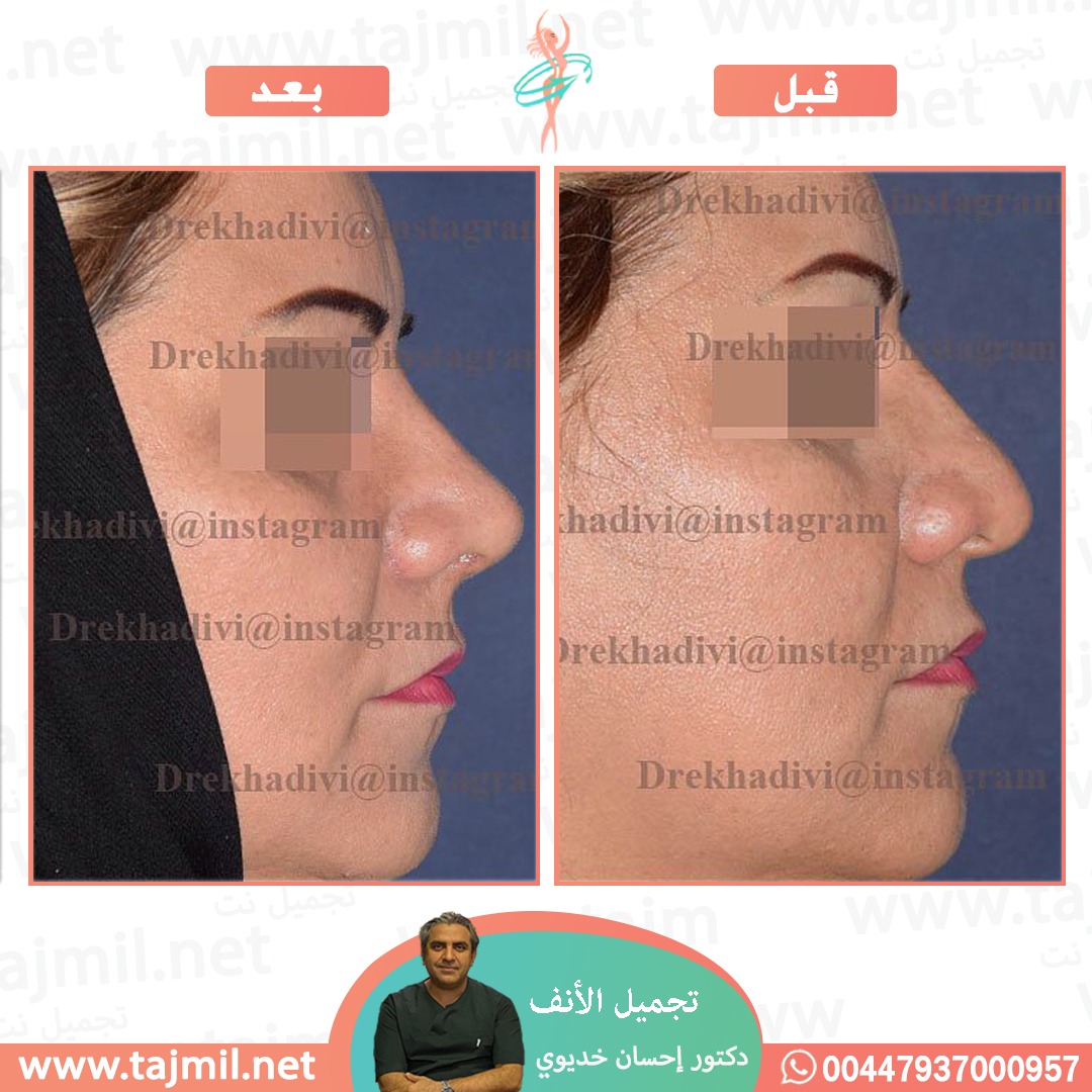  - دکتور إحسان خدیوي عملية تجميل الانف في ايران مع تجميل نت