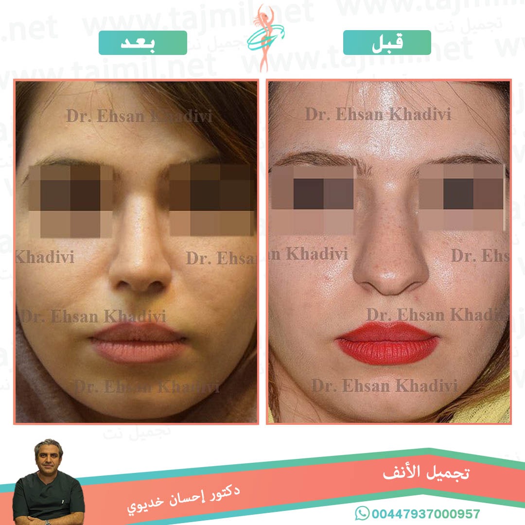  - دکتور إحسان خدیوي عملية تجميل الانف في ايران مع تجميل نت