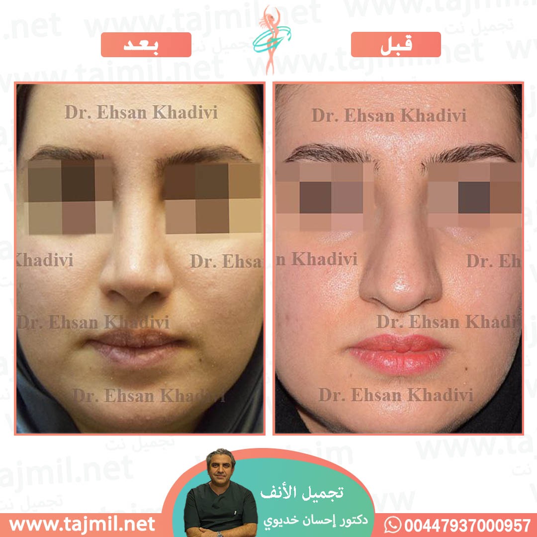  - دکتور إحسان خدیوي عملية تجميل الانف في ايران مع تجميل نتدکتور إحسان خدیوي عملية تجميل الانف في ايران مع تجميل نت