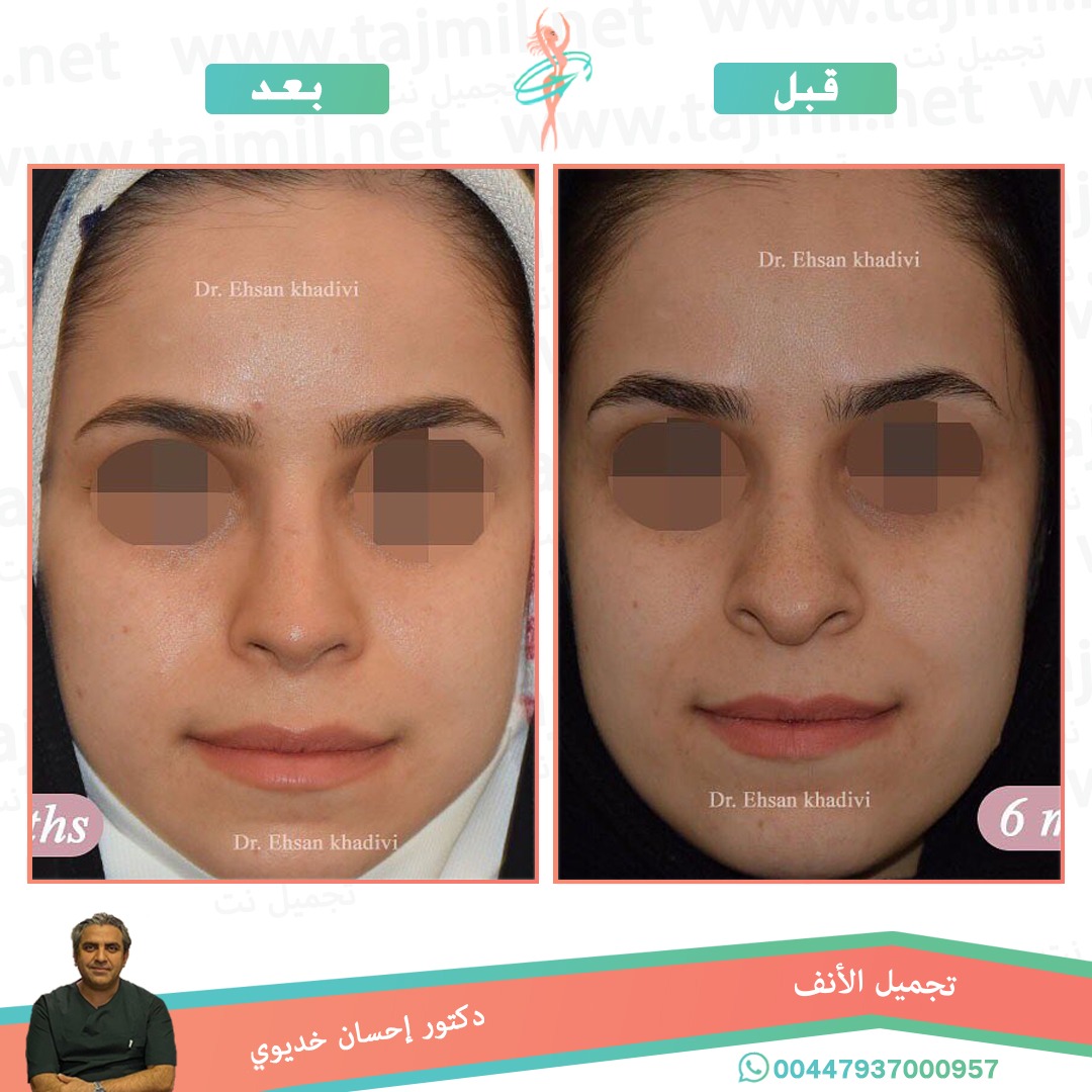  - دکتور إحسان خدیوي عملية تجميل الانف في ايران مع تجميل نت