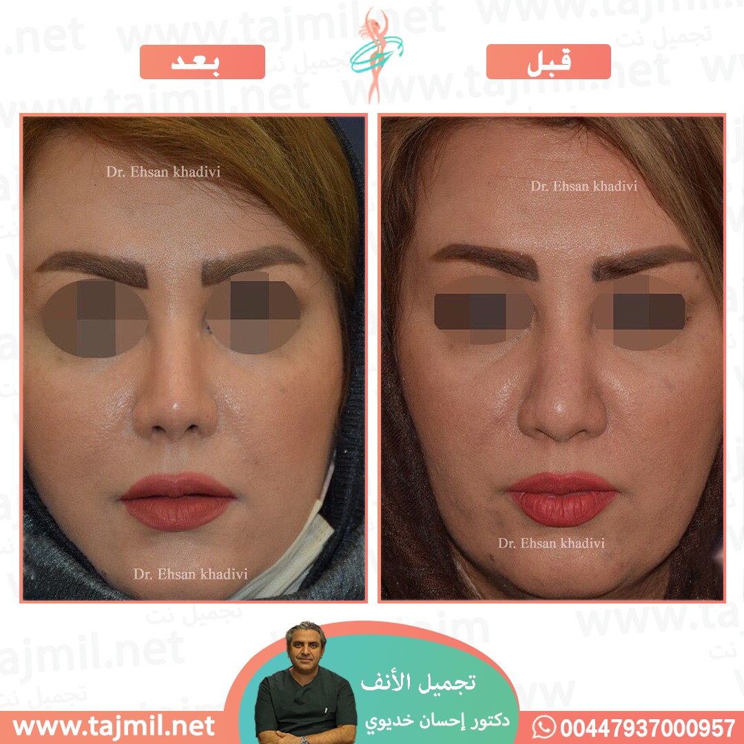  - دکتور إحسان خدیوي عملية تجميل الانف في ايران مع تجميل نت