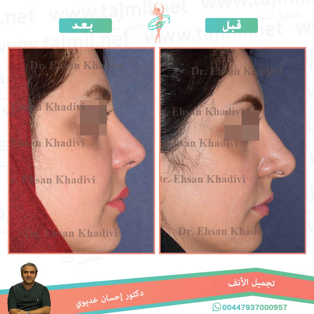  - دکتور إحسان خدیوي عملية تجميل الانف في ايران مع تجميل نت