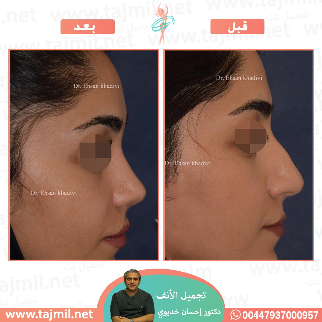  - دکتور إحسان خدیوي عملية تجميل الانف في ايران مع تجميل نت