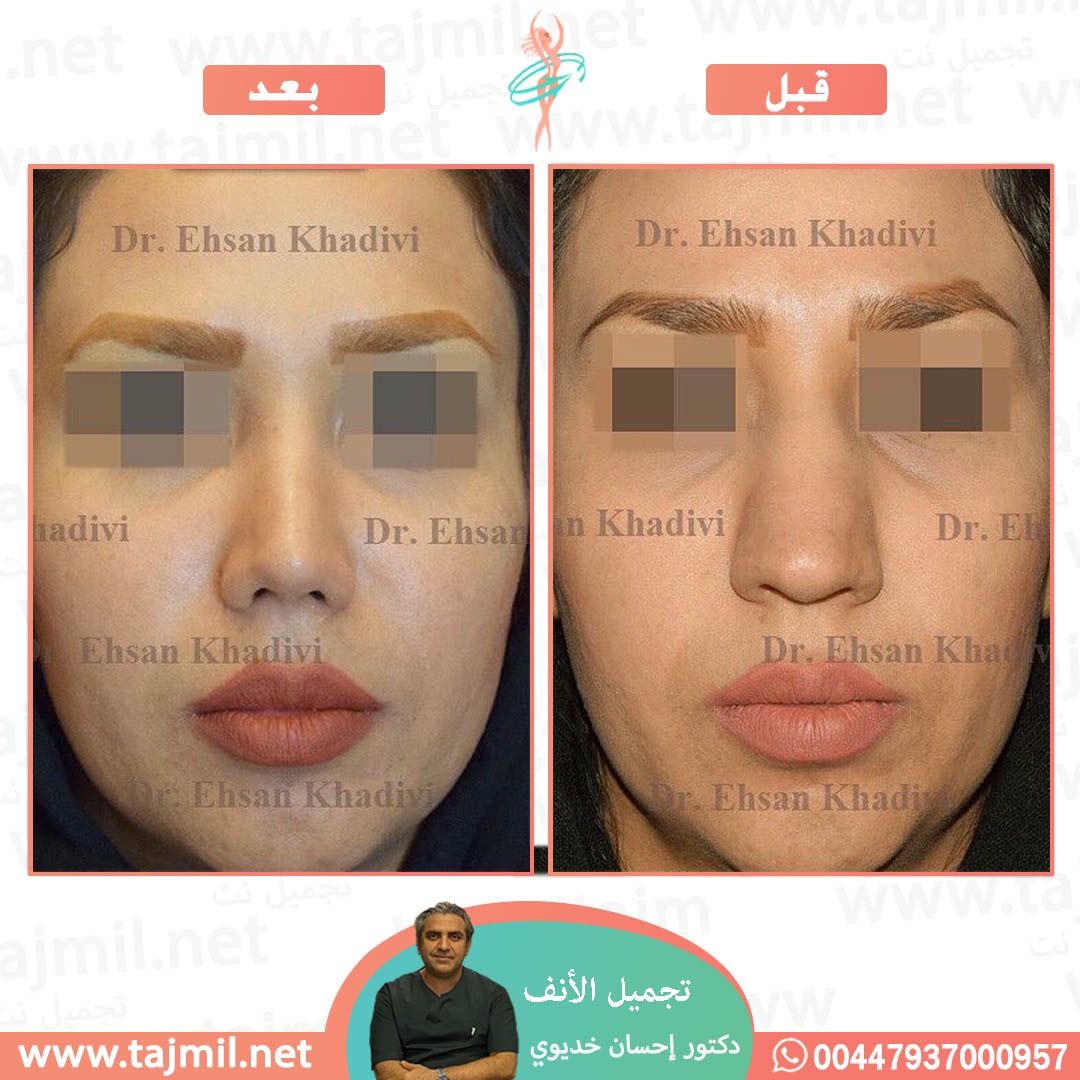  - دکتور إحسان خدیوي عملية تجميل الانف في ايران مع تجميل نت