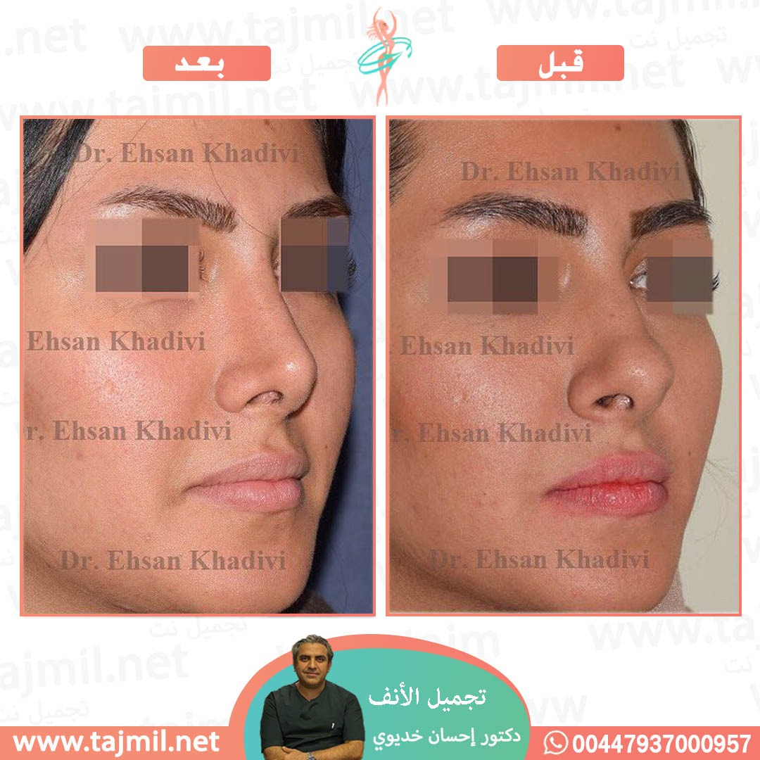  - دکتور إحسان خدیوي عملية تجميل الانف في ايران مع تجميل نت